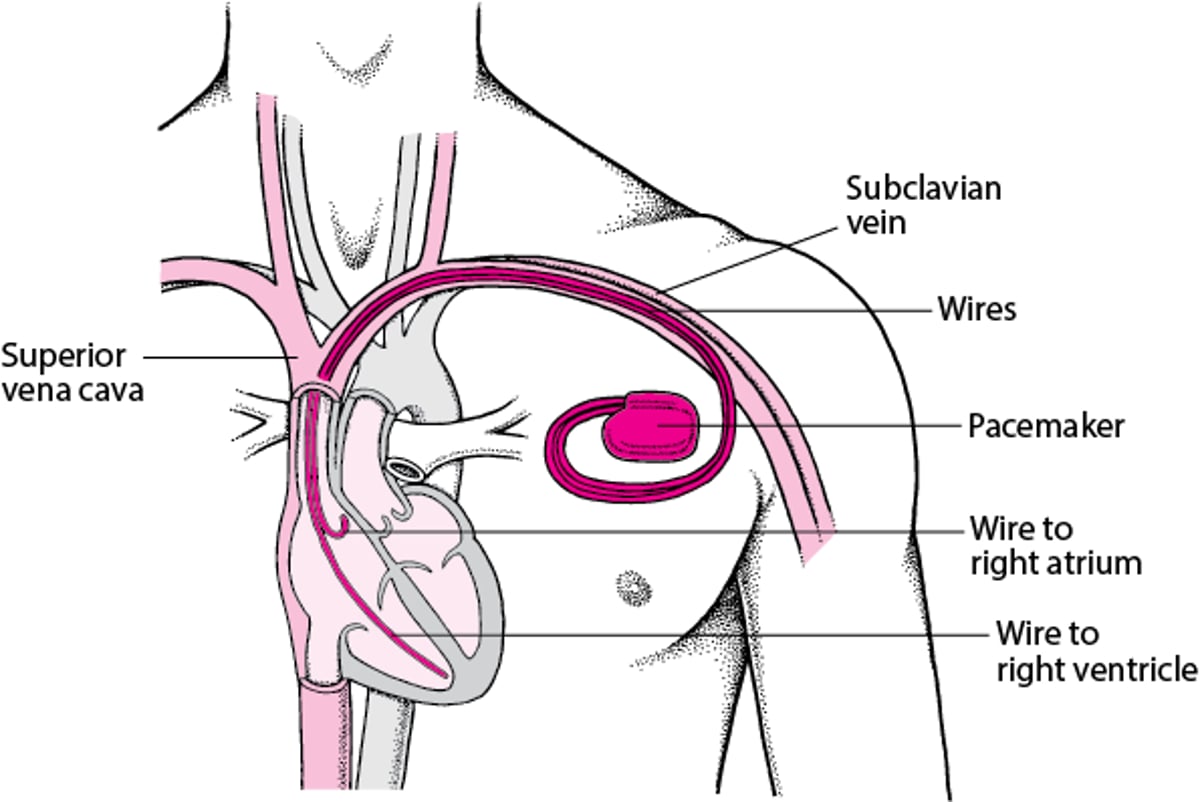 Kudumisha Mapigo: Vidhibiti Bandia vya Mapigo ya Moyo