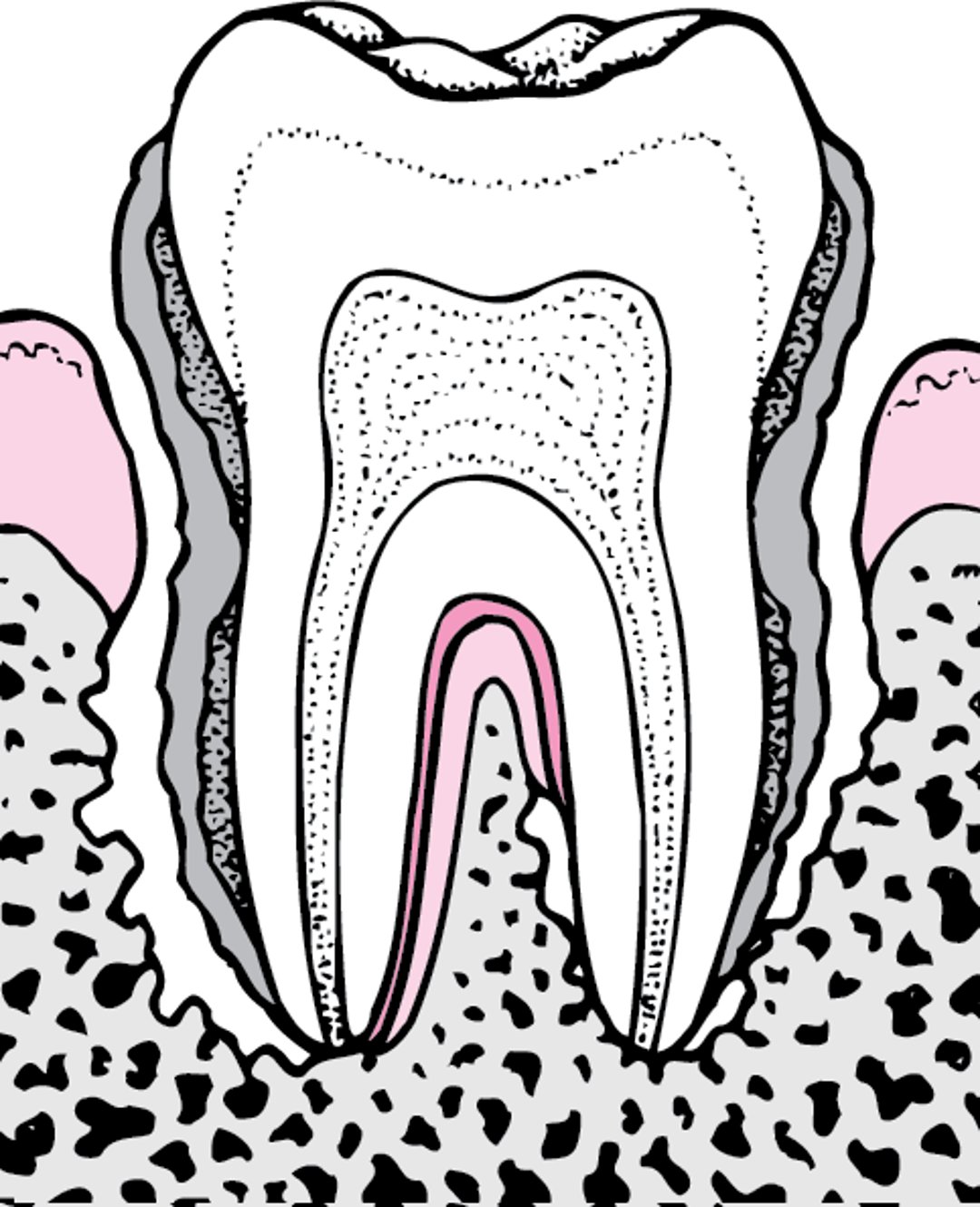 Periodontitisi: Kutoka Utando hadi Kupoteza Jino