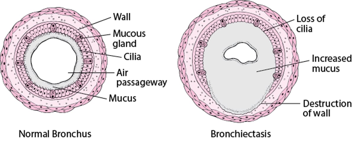 Kuelewa Bronchiectasis