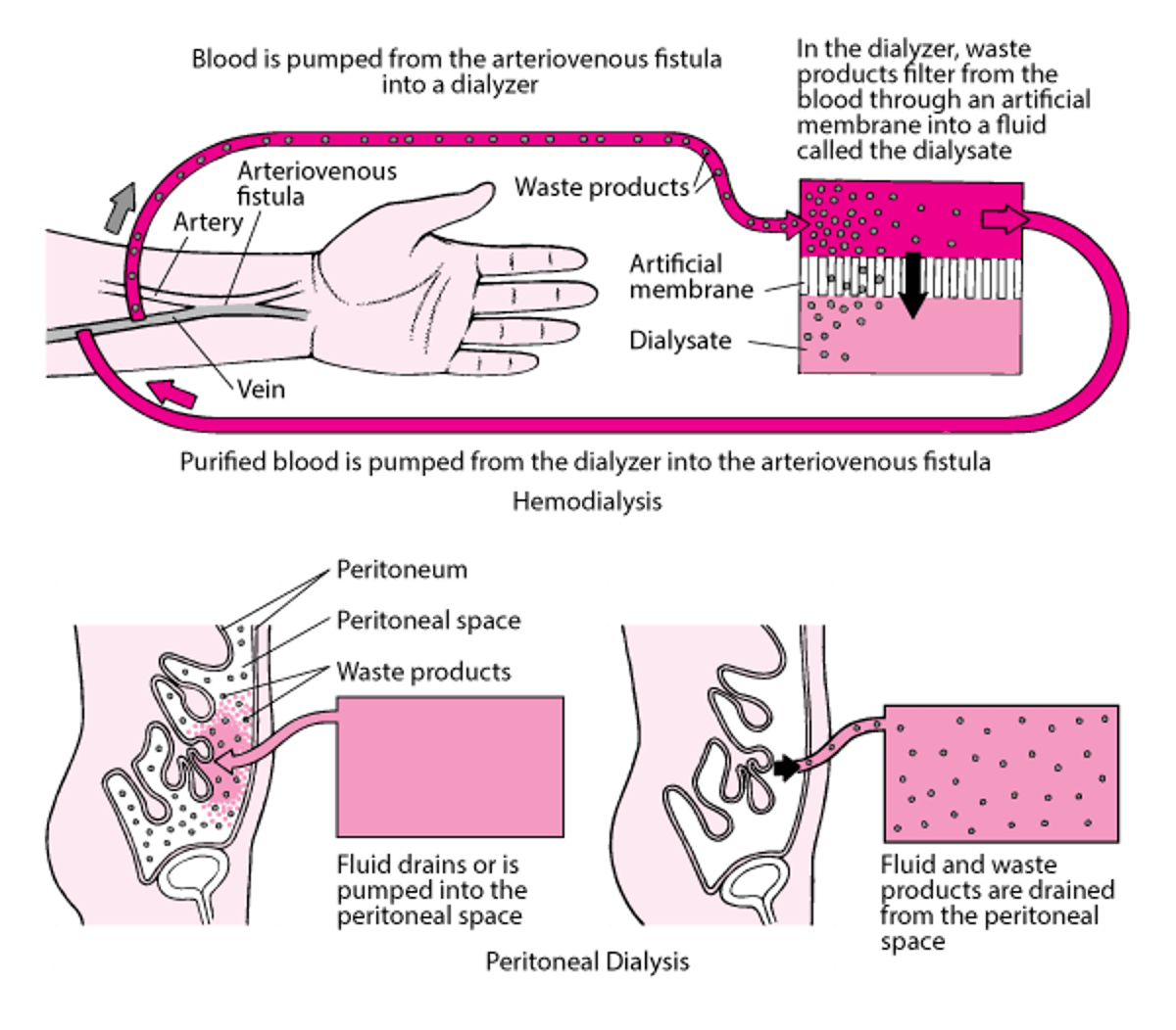 Kulinganisha Hemodialisi na Usfishaji damu wa Peritoneal