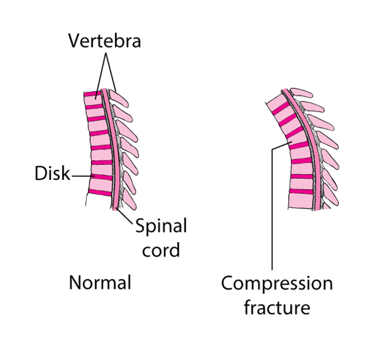 Uti wa Mgongo Kuvunjika kwa Kubanwa