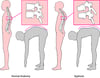 Kyphosis: Kibyongo