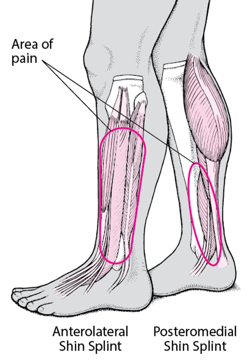 Shin Splints