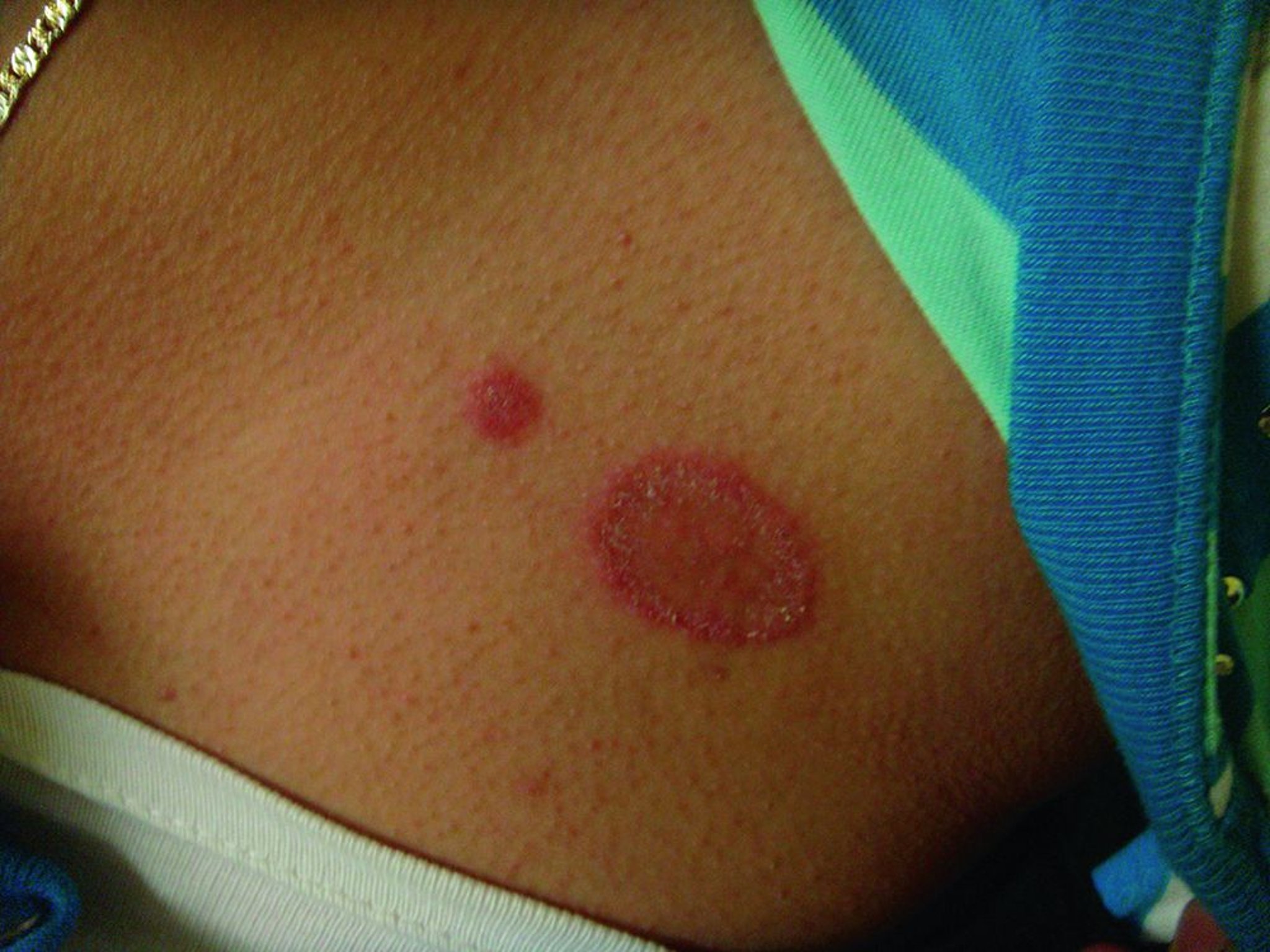 Dermatofitosi del corpo (tinea corporis) con margine desquamato