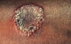 Mancha de tiña corporal (Tinea corporis) con oscurecimiento en el centro