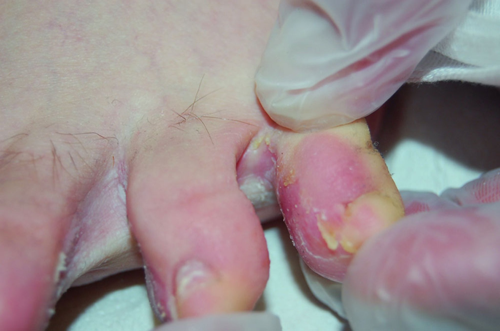 Scaling and Breakdown of Skin in Athlete's Foot (Tinea Pedis)