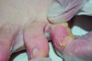 Scaling and Breakdown of Skin in Athlete's Foot (Tinea Pedis)