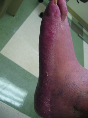 Scaling and Redness of the Foot in Athlete's Foot (Tinea Pedis)