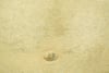 Ichthyosis on the Skin of the Abdomen