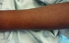 Xeroderma (Xerosis)