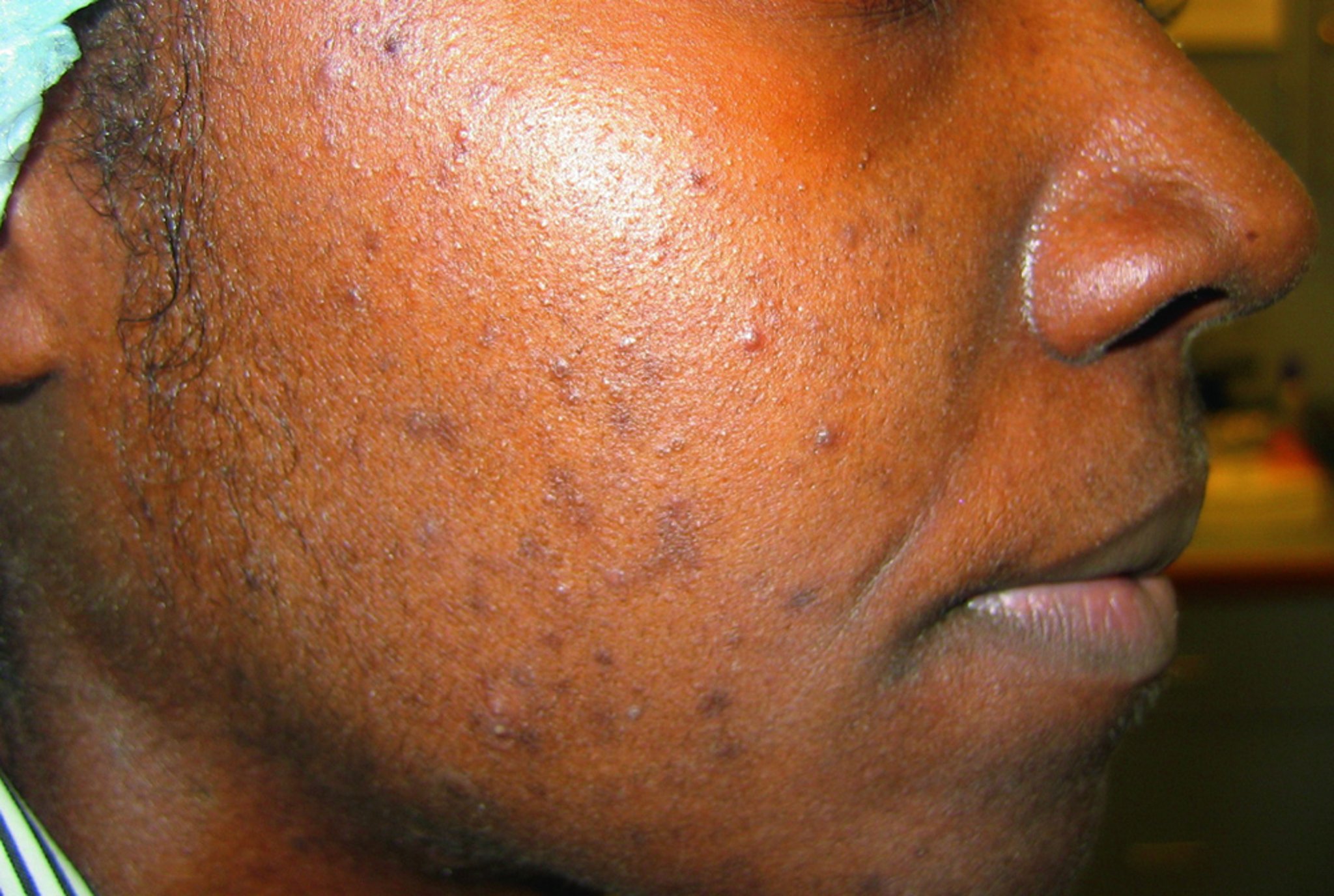 Acne infiammatoria con iperpigmentazione