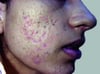 Acne con grossi punti neri e bianchi