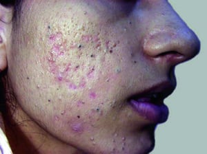 Acne con grossi punti neri e bianchi