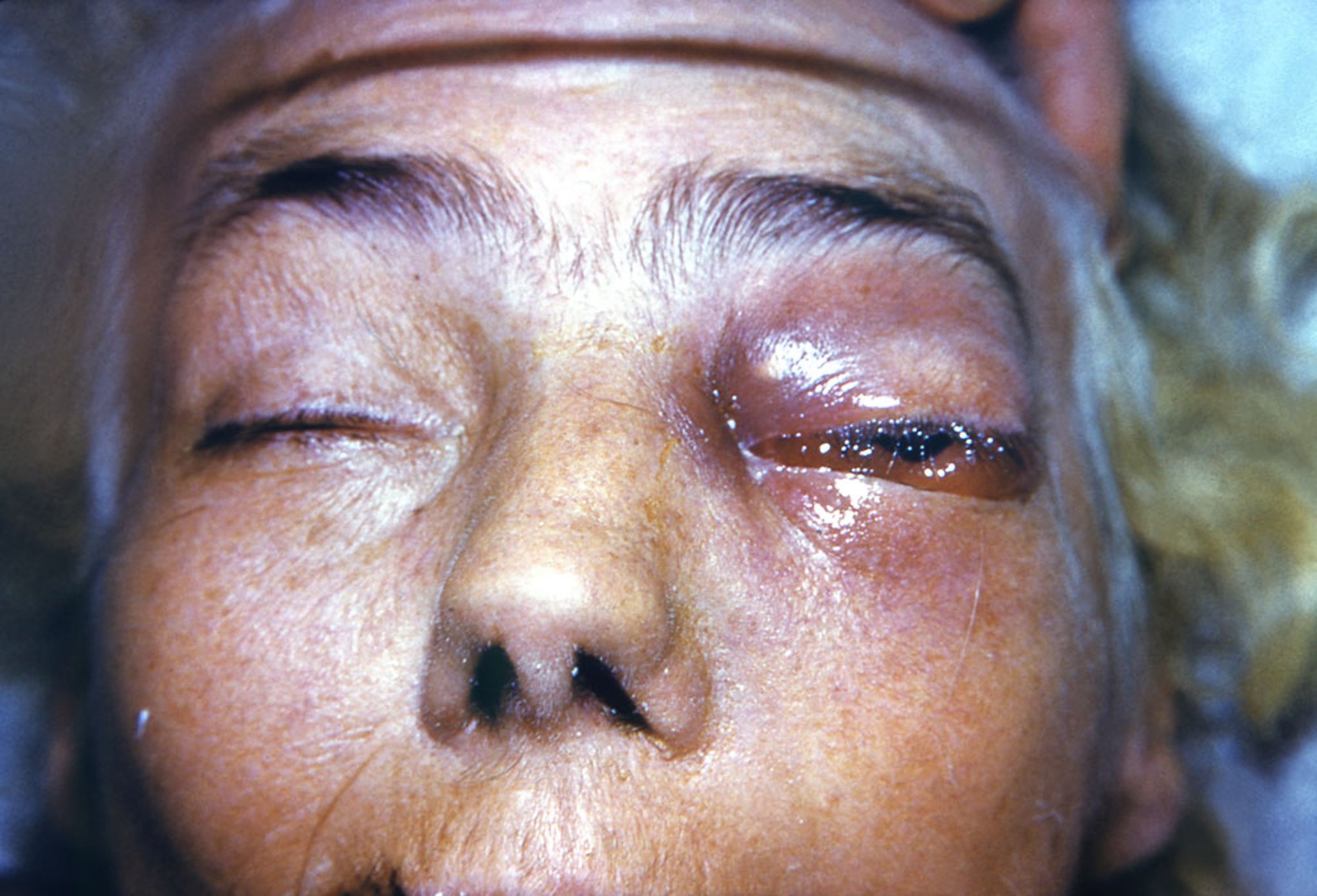 Rhino-Orbital Mucormycosis