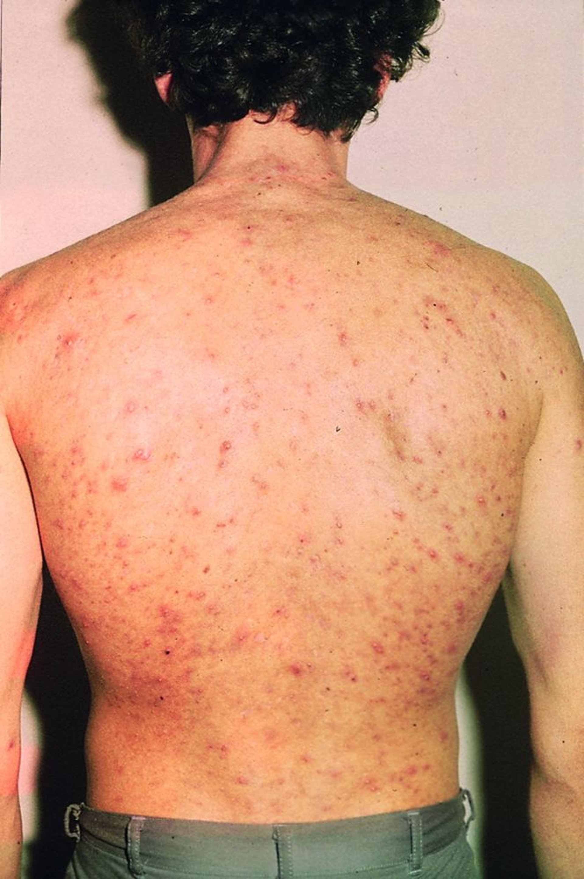Acne sul corpo
