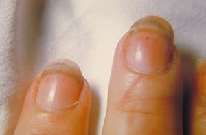 Инфекционный эндокардит (кровоизлияния у основания ногтей)