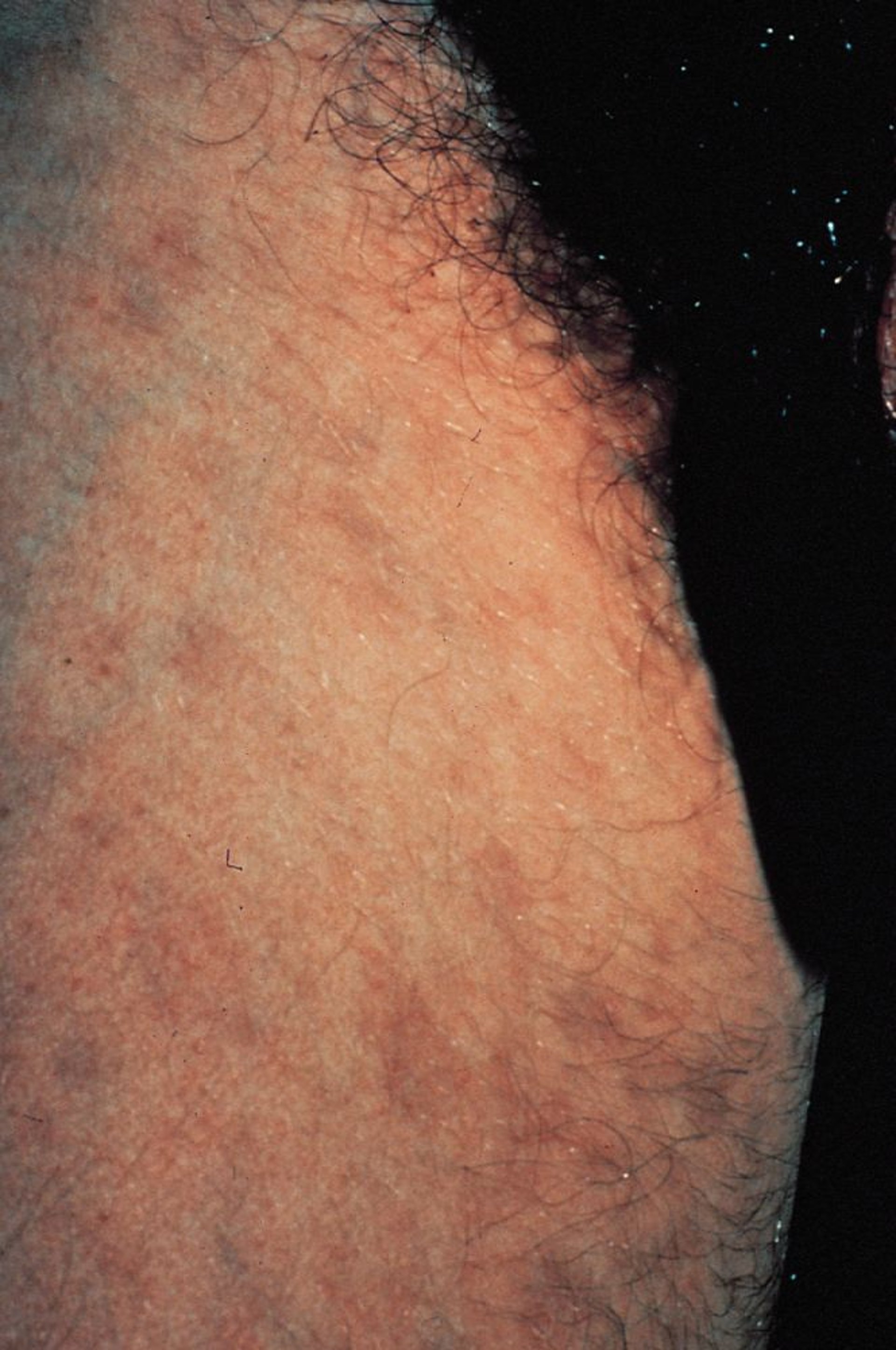 Bluish Gray Spots Caused by Pubic Lice Bites