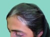 Vitiligo With Hair Depigmentation