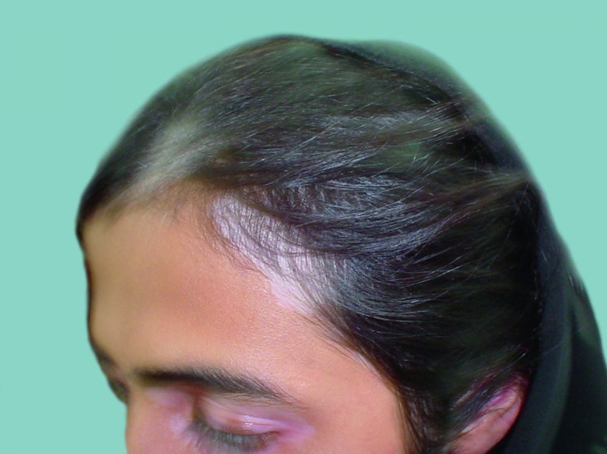 Vitiligo mit Haardepigmentierung