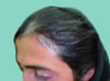 Vitiligo com despigmentação dos cabelos