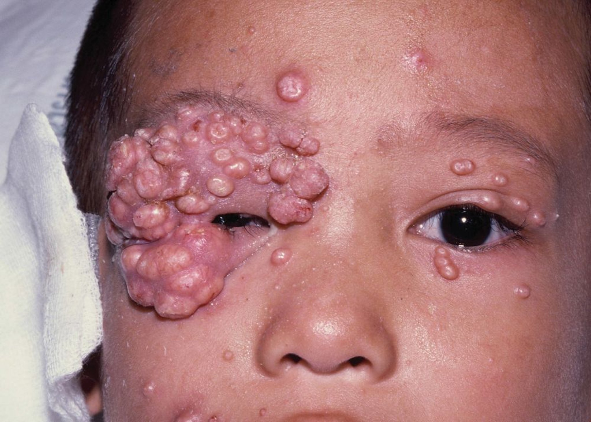 Molluscum contagiosum bei einem HIV-infizierten Kind