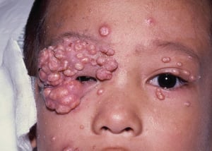 Molluscum contagiosum chez un enfant infecté par le VIH