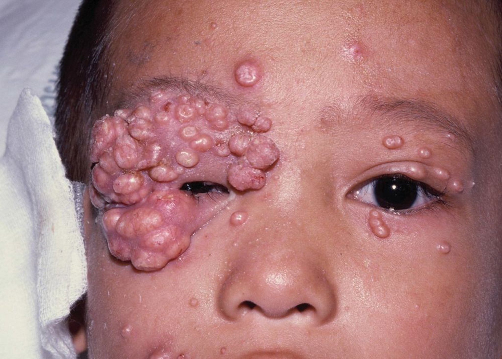 HIV 感染儿童中的传染性软疣