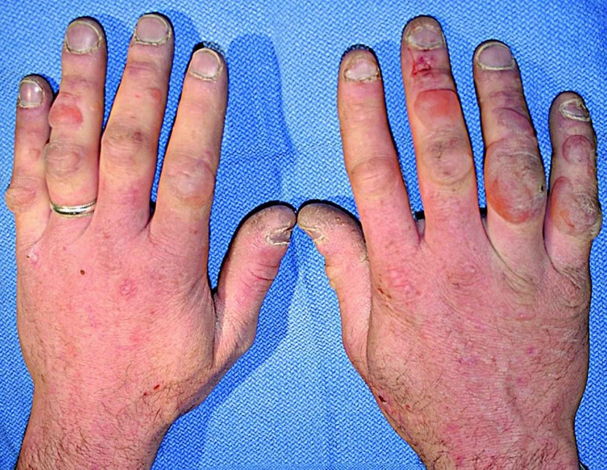 Severe Frostbite of the Hands