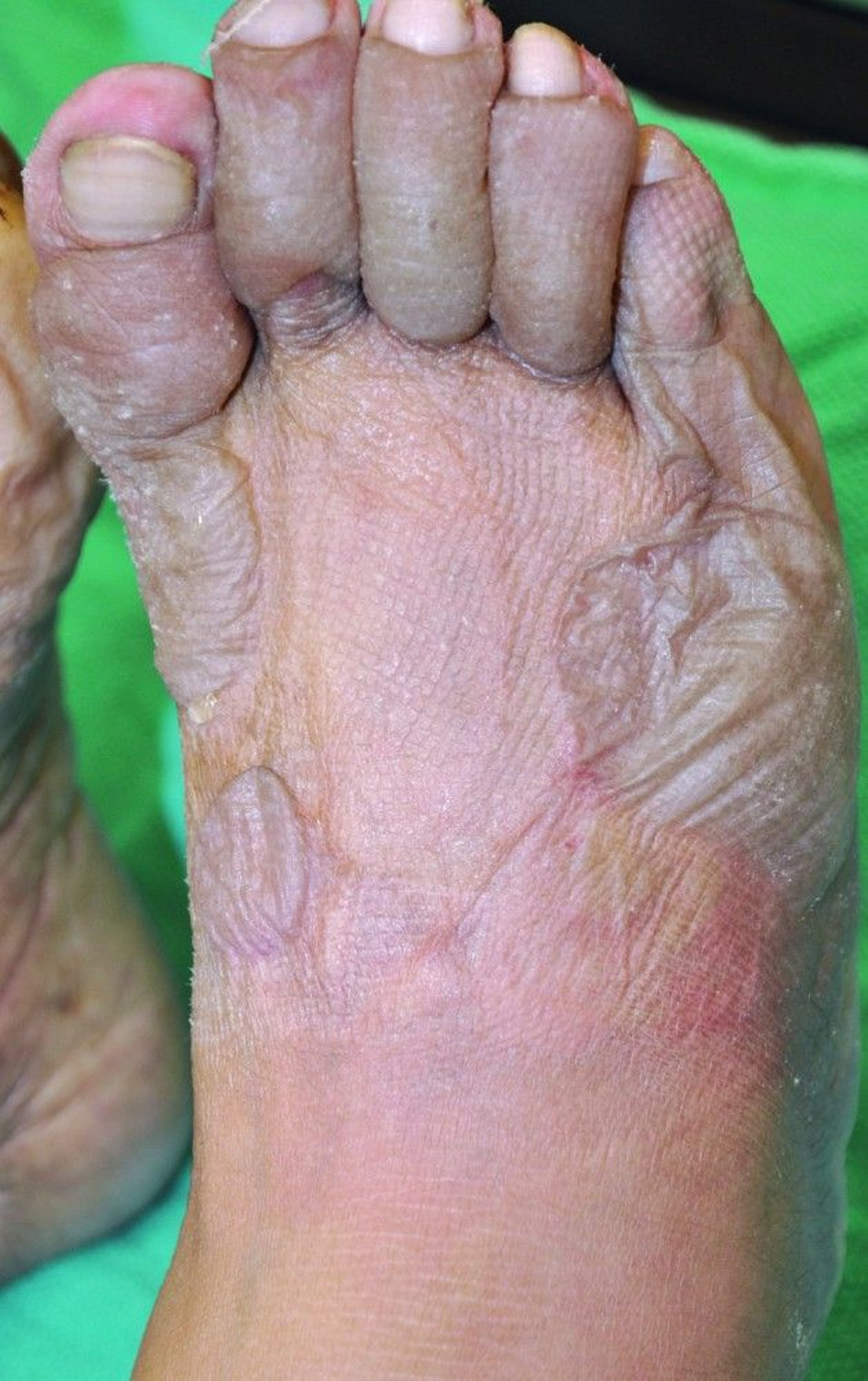 Frostbite of the Foot