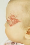 Strawberry Hemangioma
