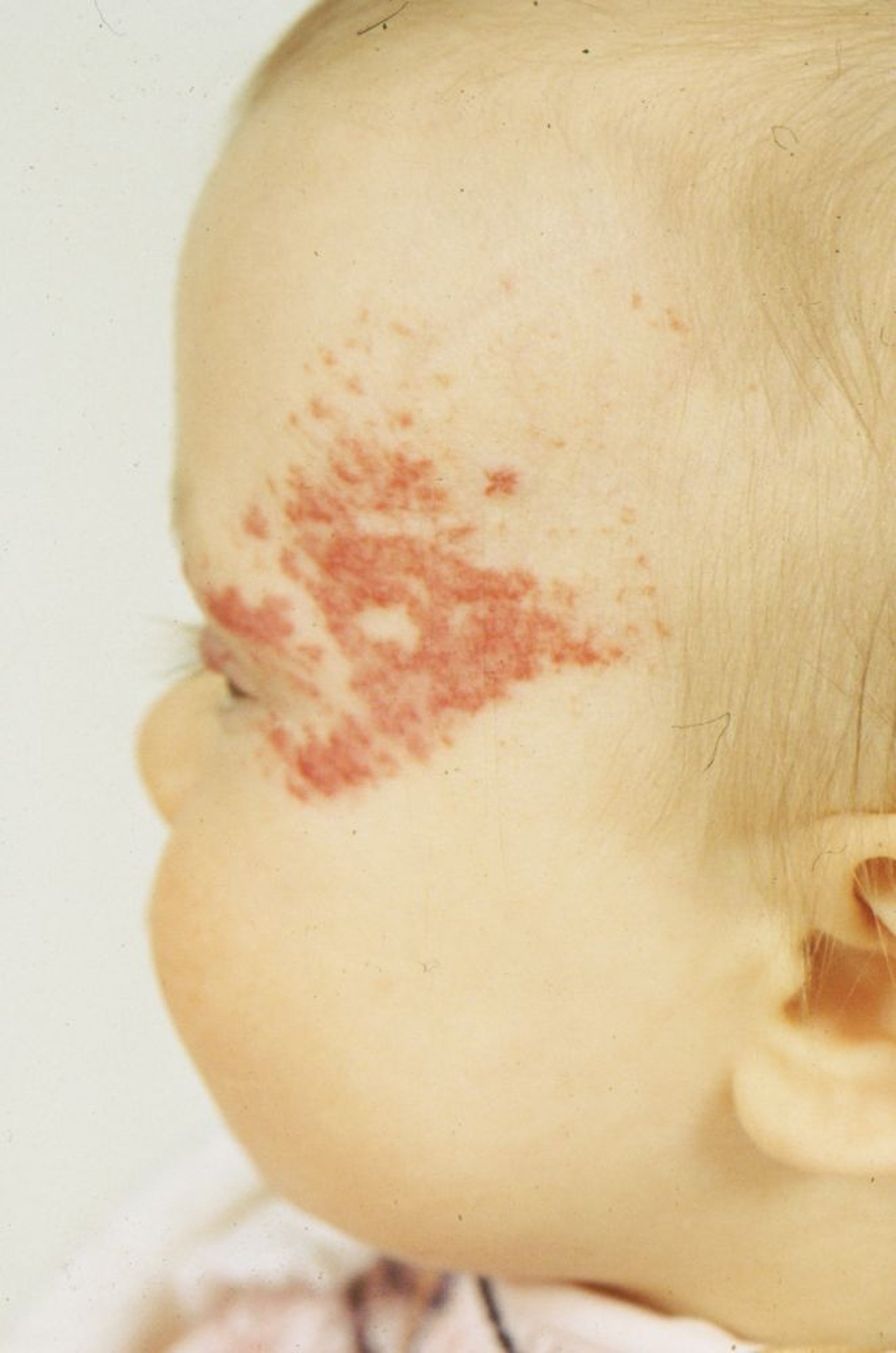 Hemangioma en fresa