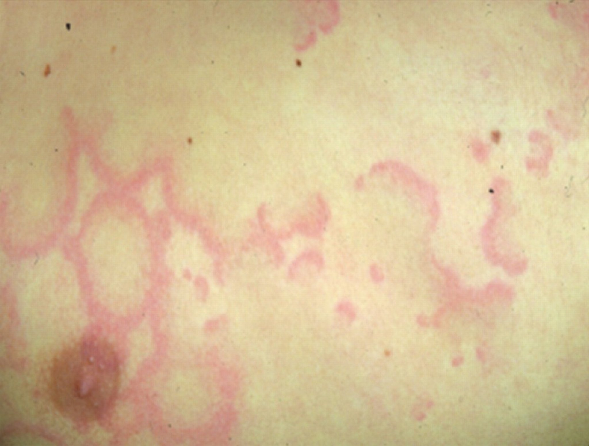 Erythema Marginatum