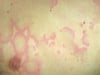 Erythema marginatum