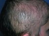 Hair-Pulling Disorder (Trichotillomania)
