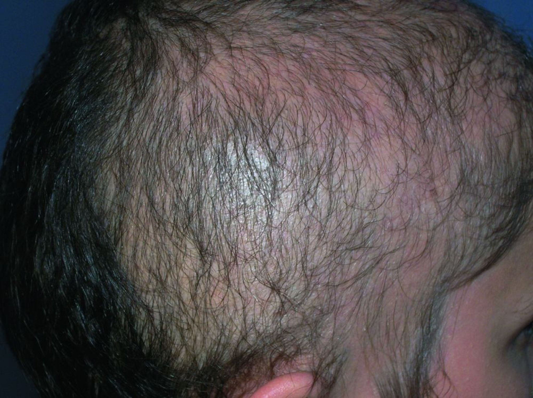 Trichotillomanie (arrachage des cheveux)