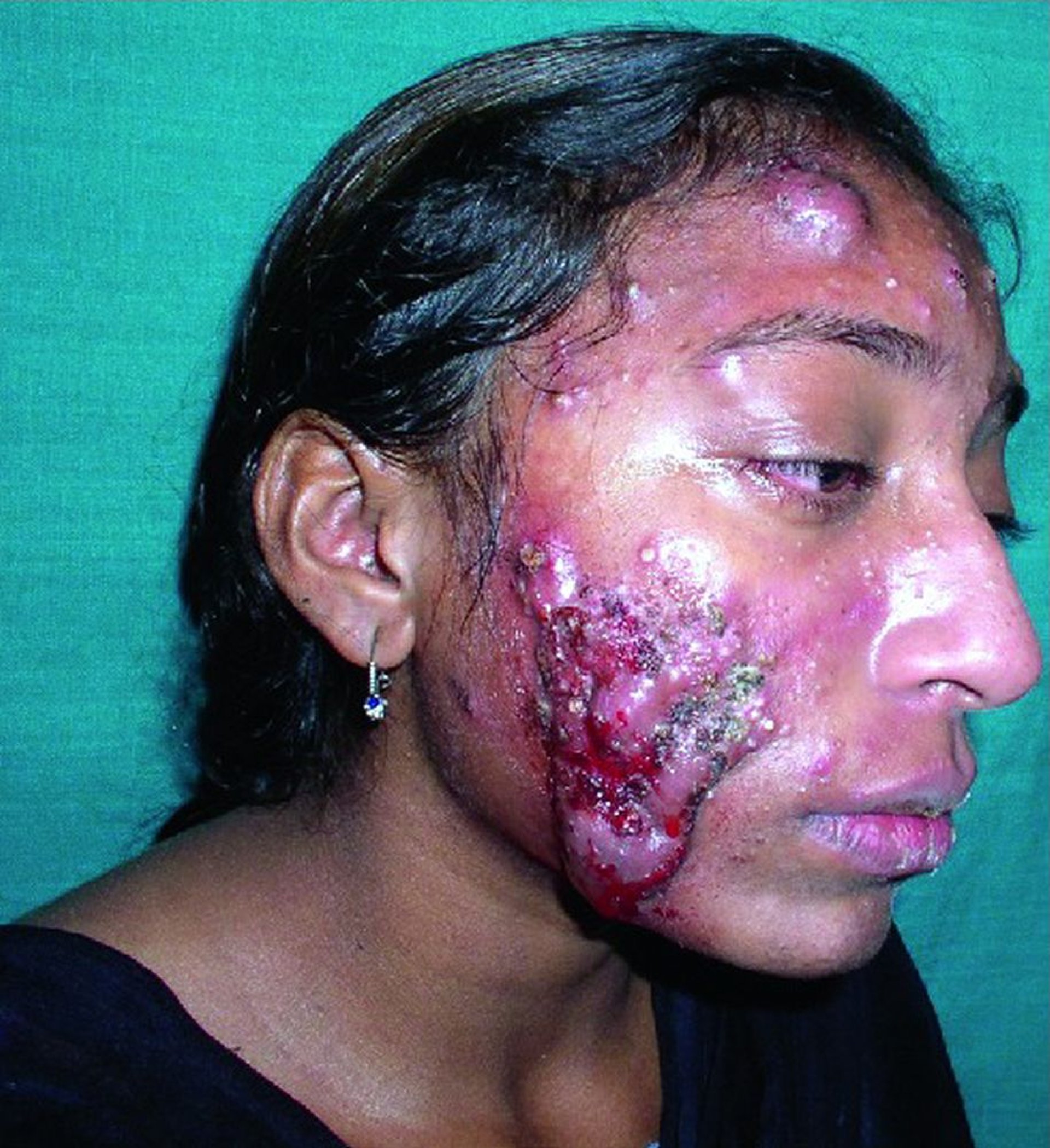 Acné conglobata sur le visage