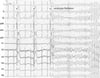 Ventricular Fibrillation