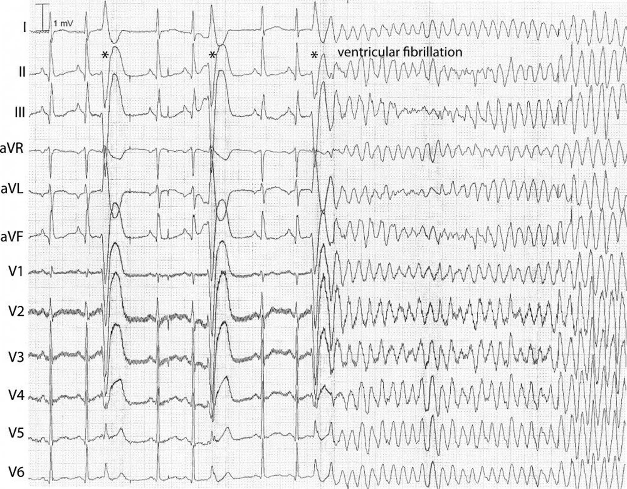 Ventricular Fibrillation