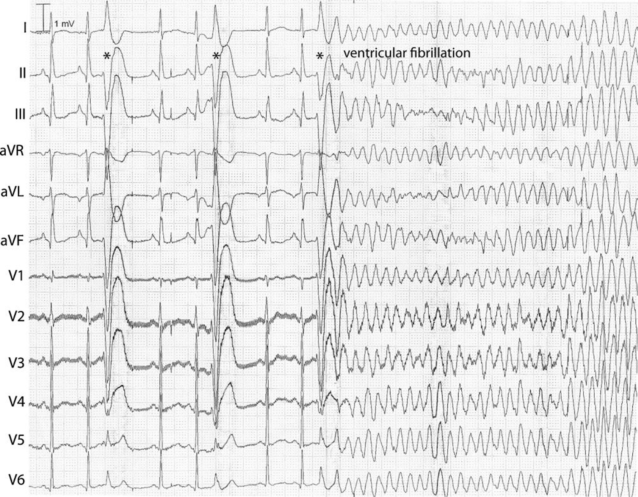 Fibrillation ventriculaire