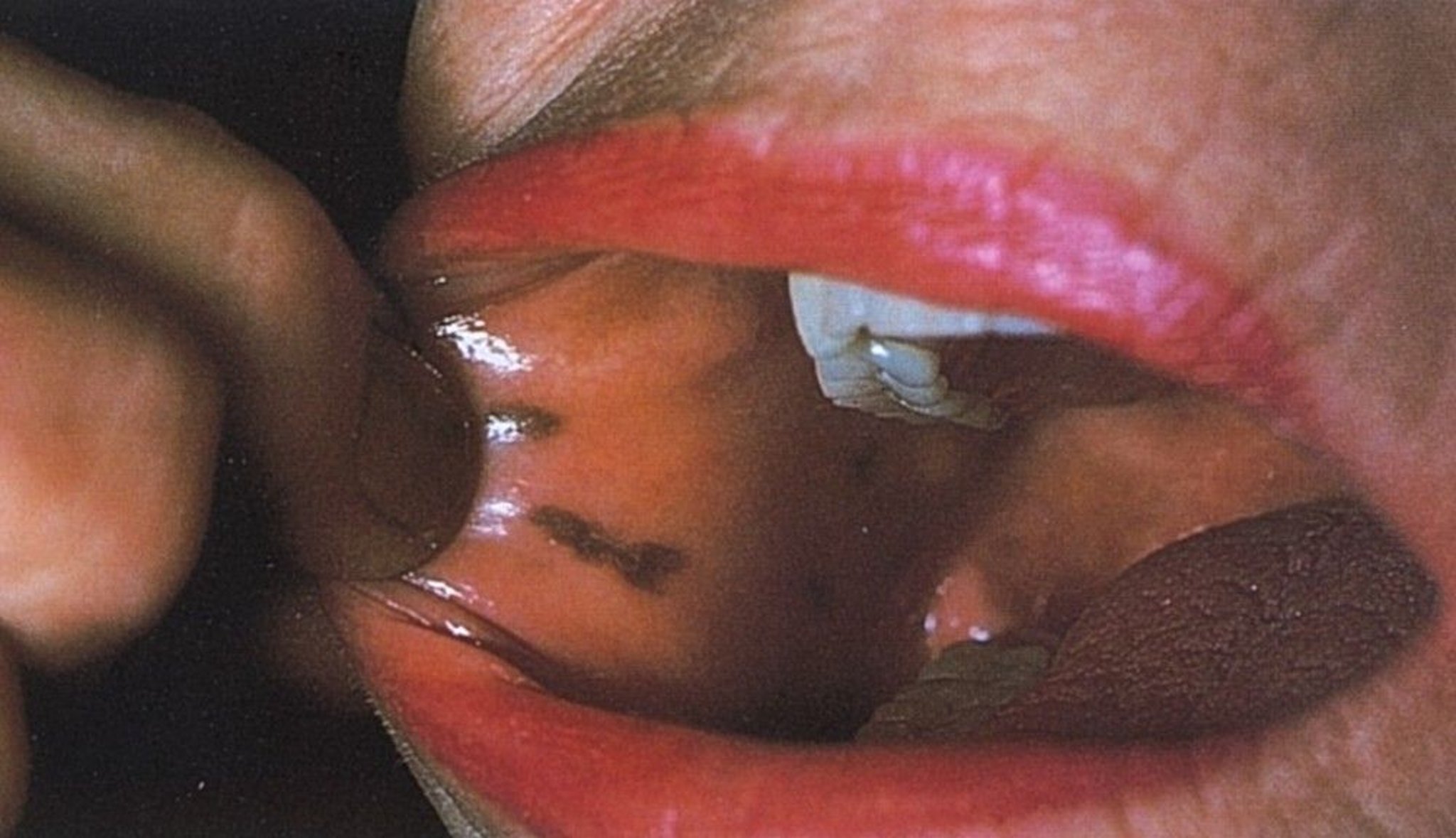 Bluish Black Spots Inside the Mouth (Peutz-Jeghers Syndrome)