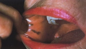 Pontos negro-azulados no interior da boca (síndrome de Peutz-Jeghers)