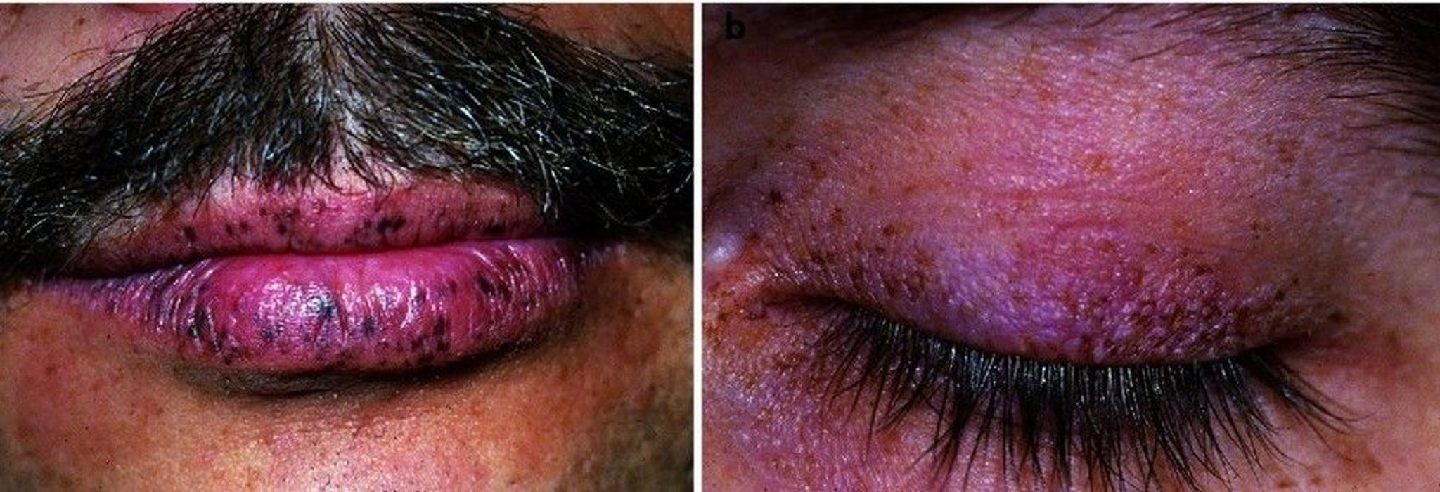 Bluish Black Spots on the Skin and on the Lips (Peutz-Jeghers Syndrome)
