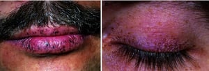 Taches bleu-noir sur la peau et les lèvres (syndrome de Peutz-Jeghers)