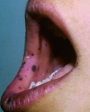 口腔内と口唇上の黒褐色の斑点（ポイツ-イェガース症候群）