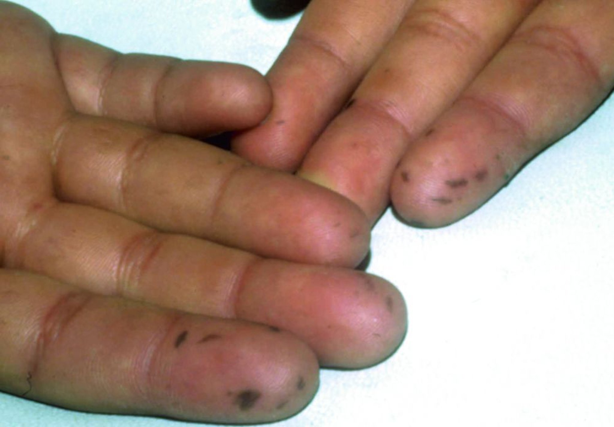 Taches bleu-noir sur les doigts (syndrome de Peutz-Jeghers)