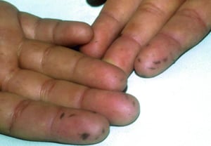 손가락의 검푸른색 반점(포이츠-제거스 증후군)