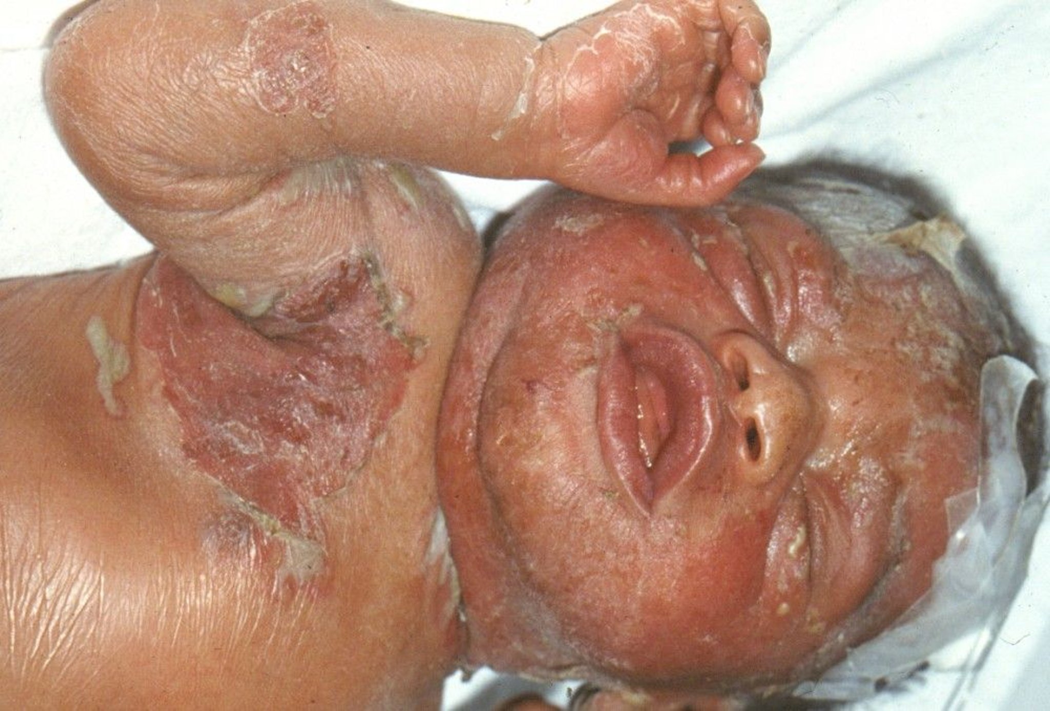 Syphilis in the Newborn (Rash)
