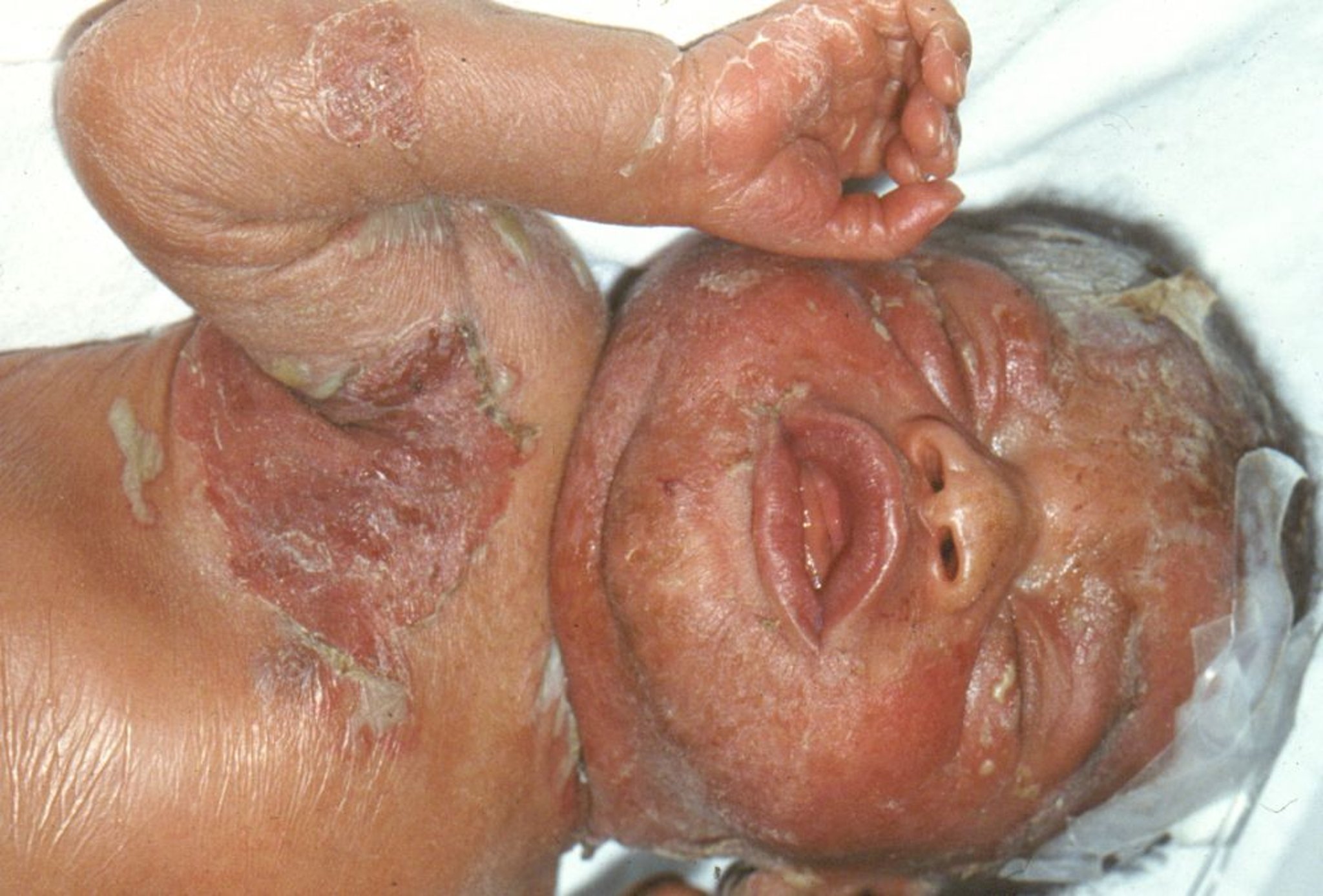 新生児の梅毒（発疹）