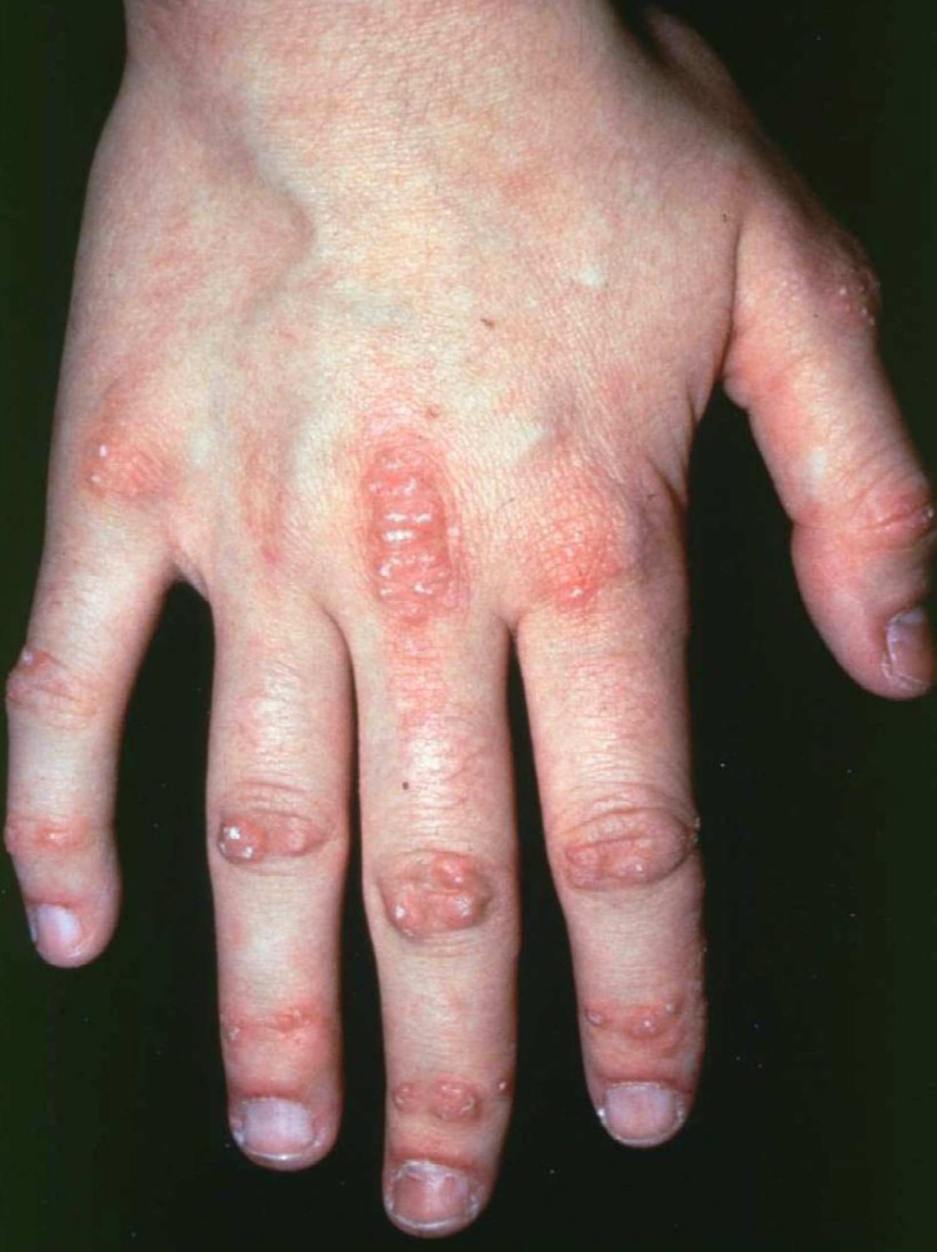 Symptômes au niveau de la main dans la dermatomyosite