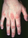 Sintomas nas mãos na dermatomiosite